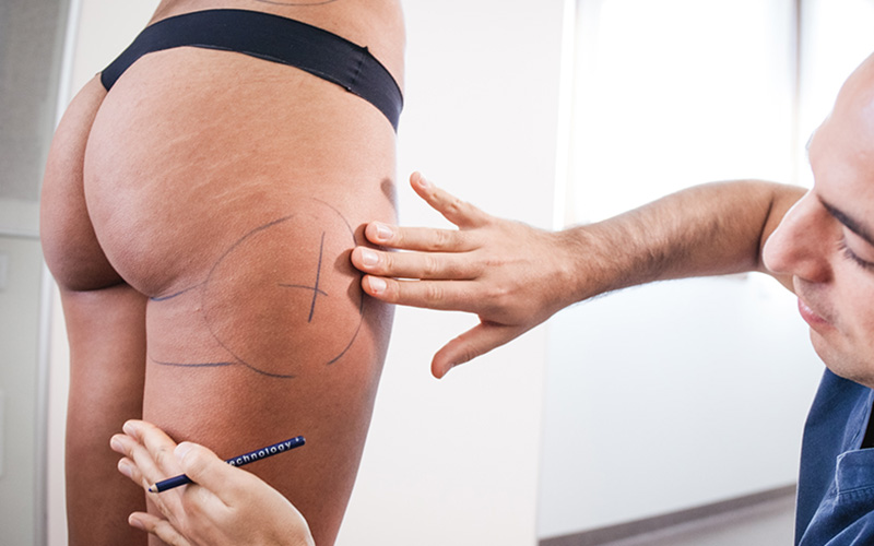 Advances in liposuction create safer, more effective body-contouring  options, Plastic Surgery