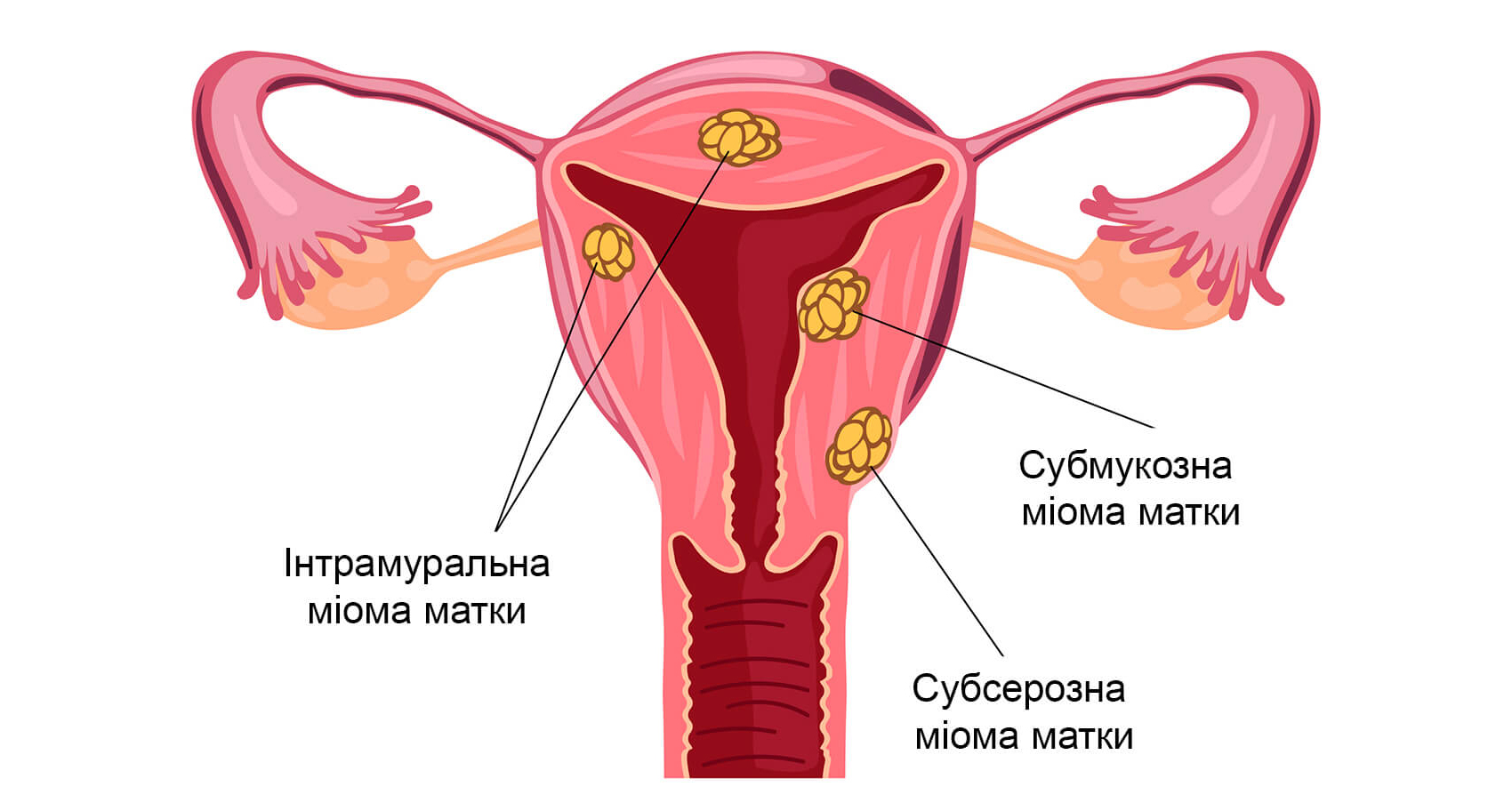 Миома матки виды