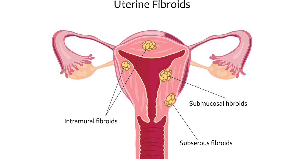 Types of uterine fibroids