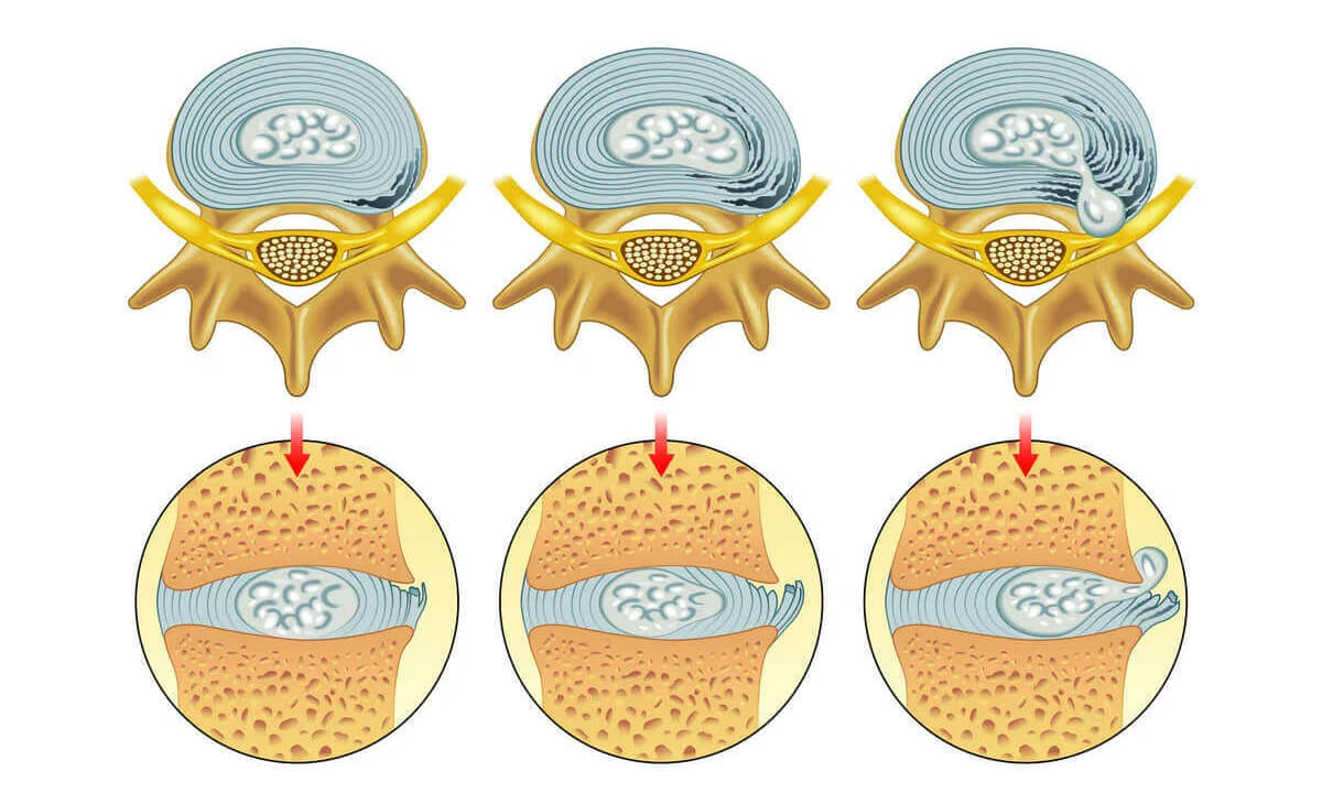 Грыжа межпозвоночного диска — симптомы, диагностика и лечение в лучших  клиниках