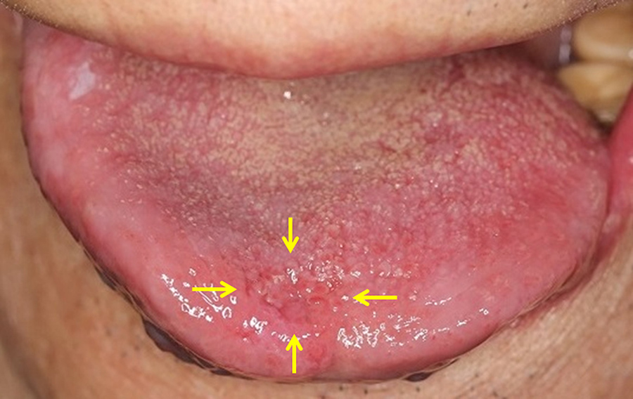 squamous cell carcinoma tongue stage 1