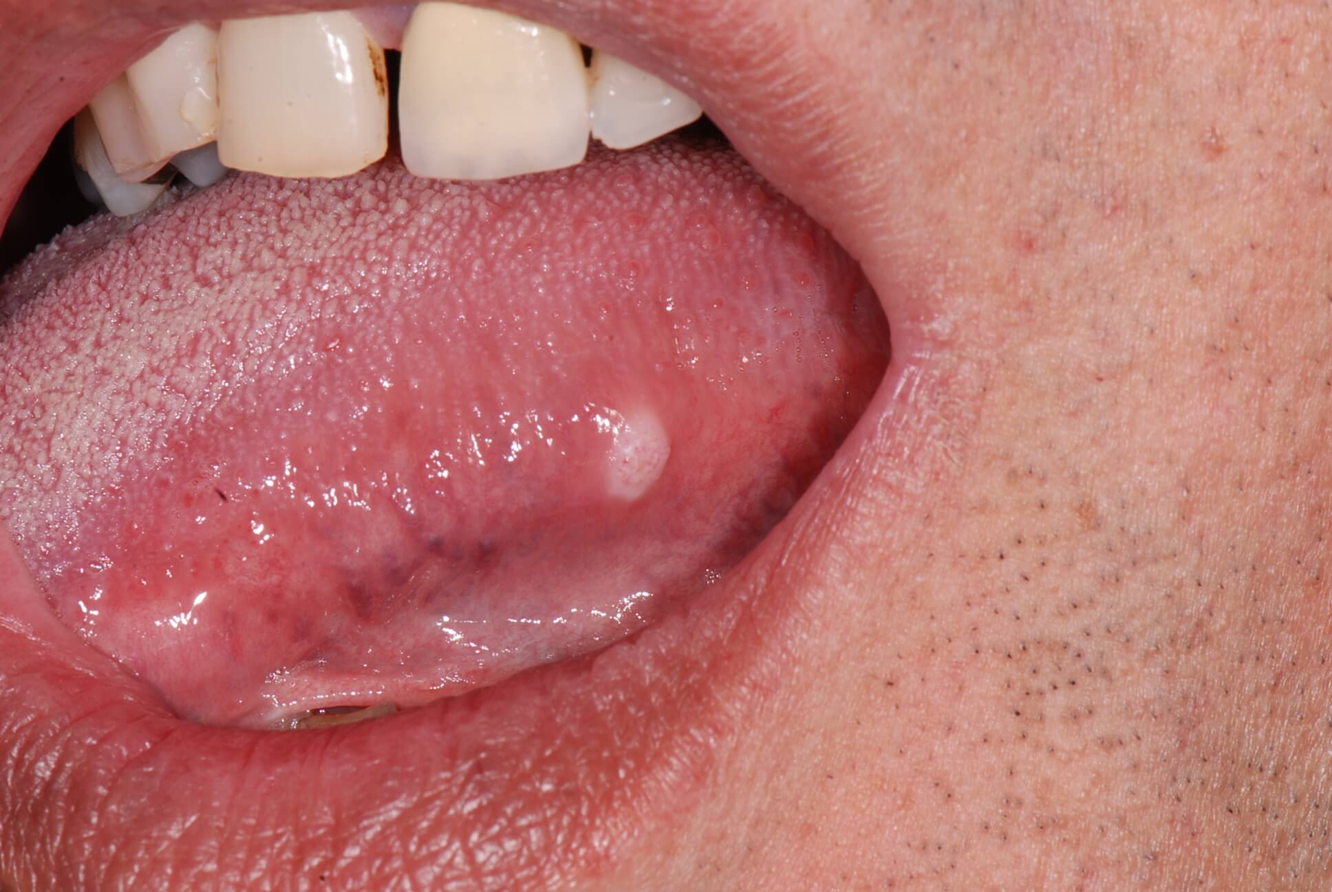cancer tongue ulcer        <h3 class=