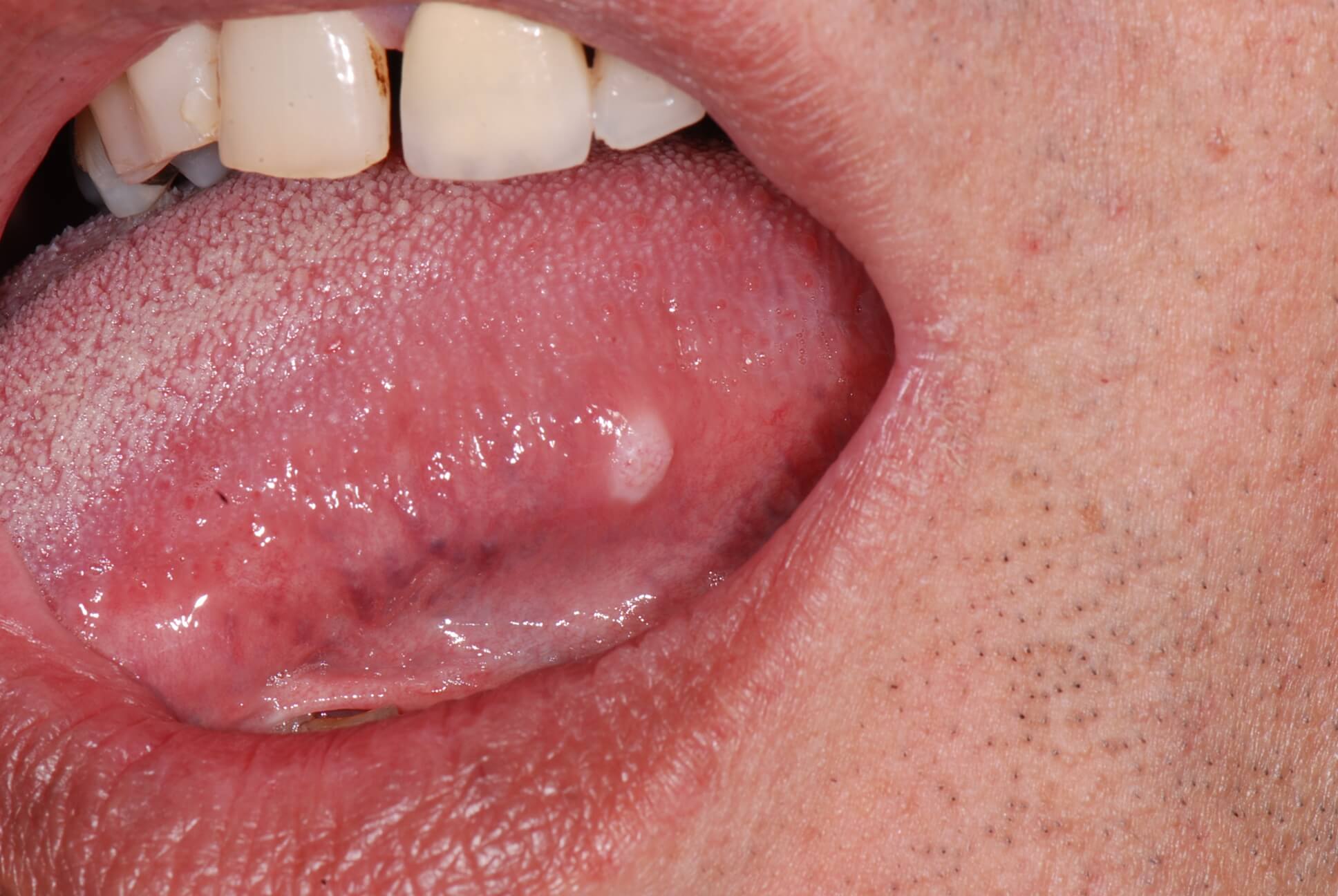 Tongue Cancer tumor Symptoms Causes Diagnosis And Treatment In 