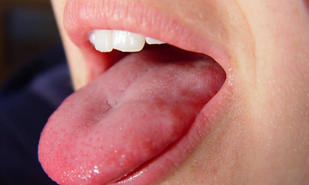 Cancer (tumor) of the tongue