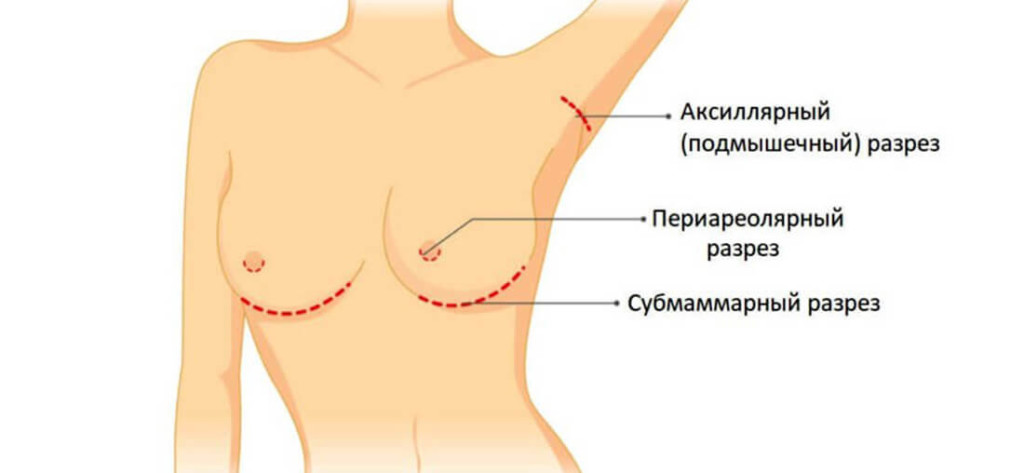 10 способов увеличить грудь без операции