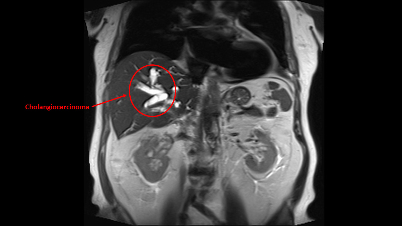 cholangiocarcinoma