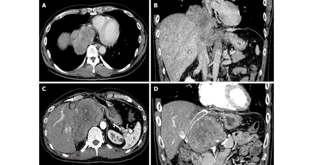 Fibrosarcoma Symptoms Causes Diagnosis And Treatment In The Best Clinics 2827