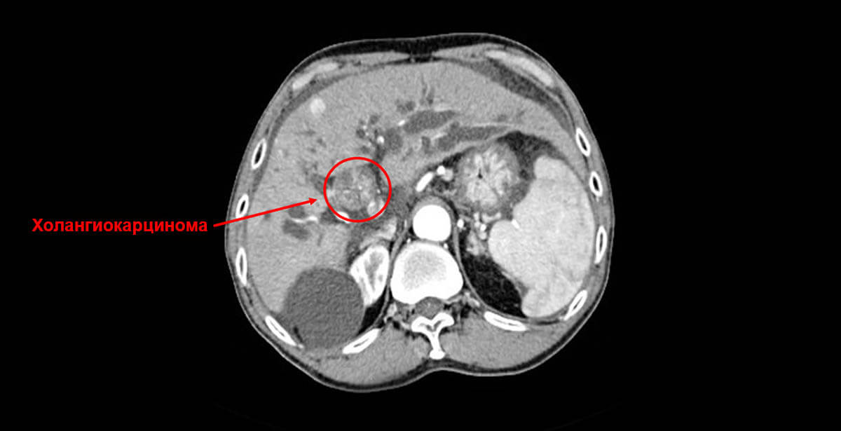 холангиокарцинома что это такое