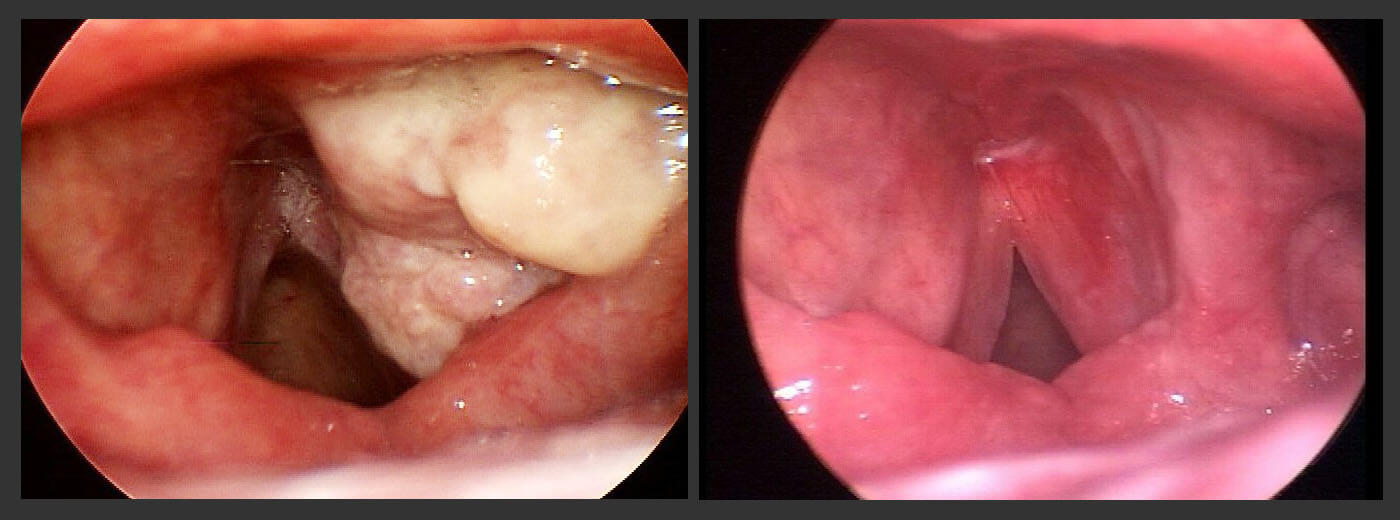 Папилломы в горле – лечение папилломатоза гортани