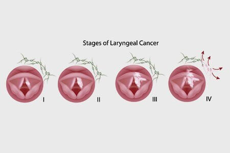 рак гортани стадии