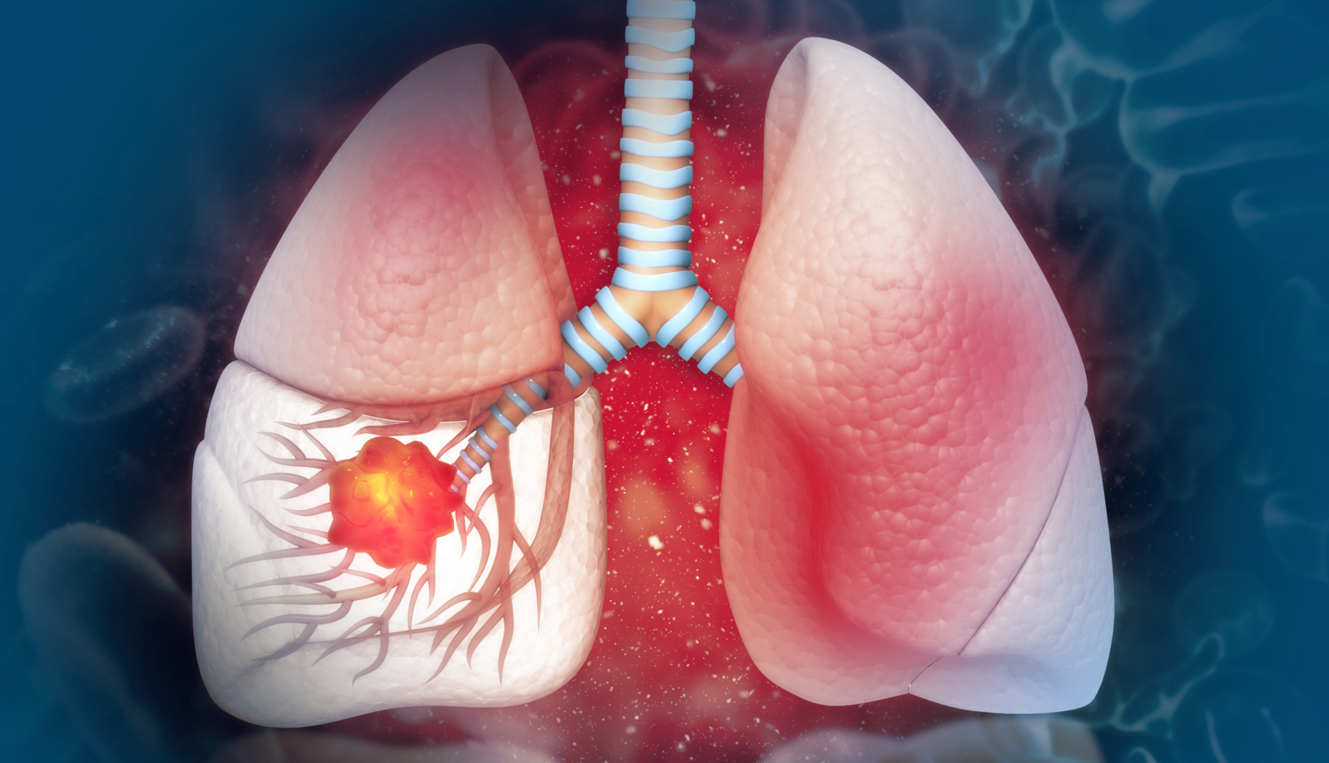 Lung sarcoma. What is the difference between cancer and sarcoma?