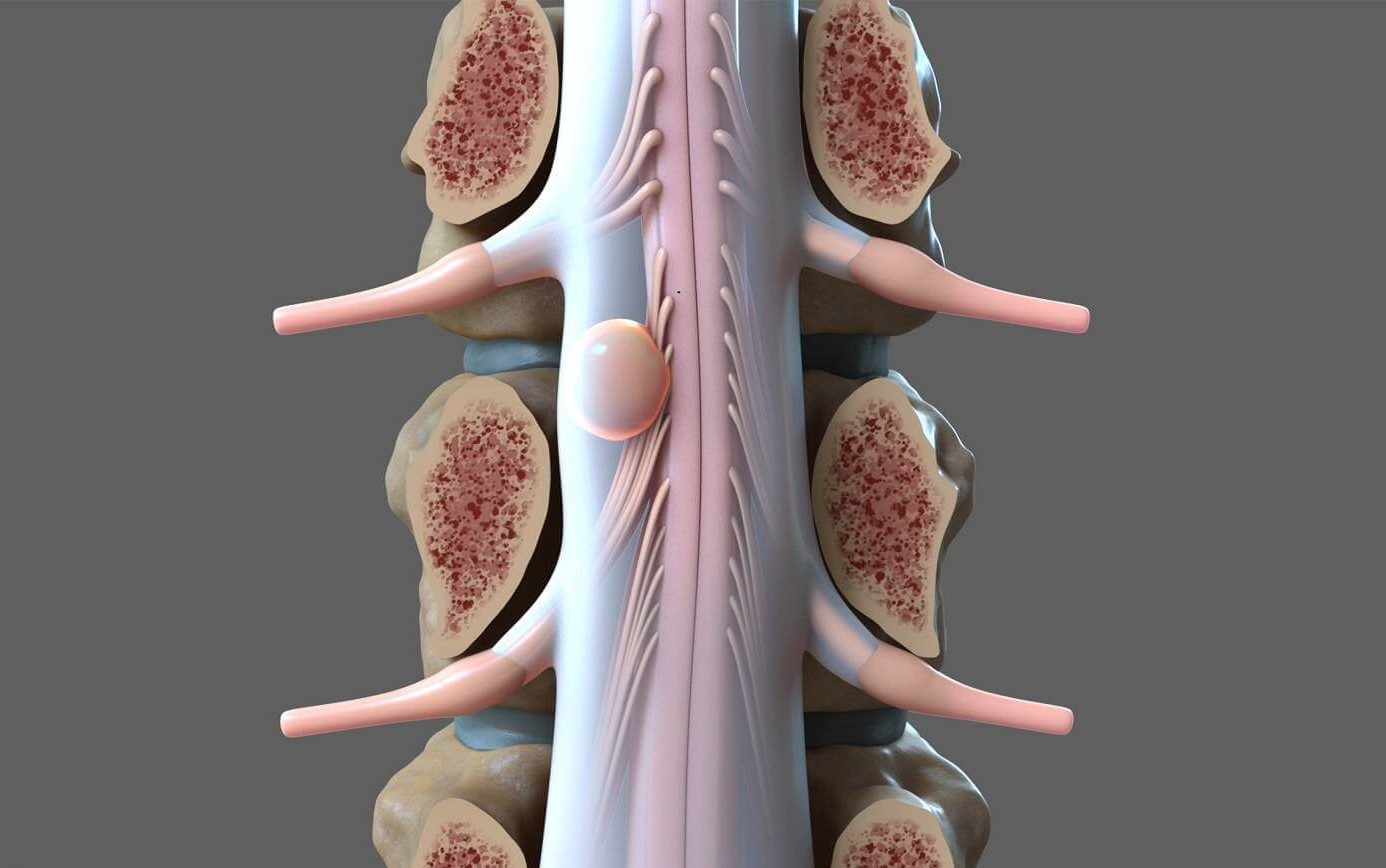 Опухоли (рак) спинного мозга - симптомы, причины, диагностика и лечение в  лучших клиниках MedTour