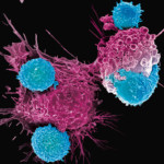 CAR T-терапия: помогает вылечить рак, когда другие методы оказываются неэффективными