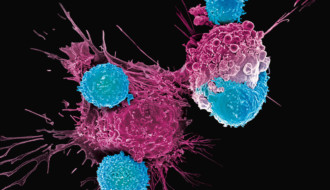 CAR T therapy: helps treat cancer when other methods fail