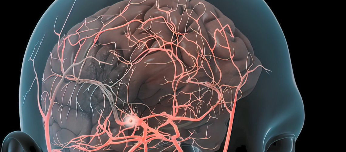 Аневризма сосудов головного мозга – симптомы, причины, диагностика и лечение в лучших клиниках