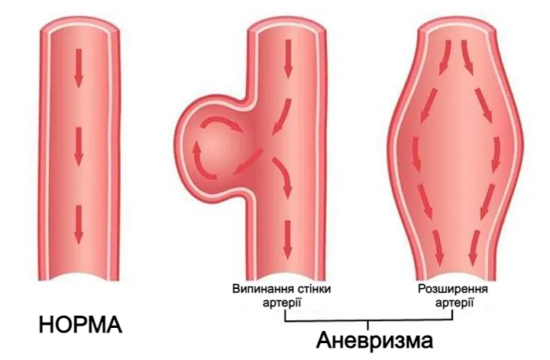 Види аневризм головного мозку