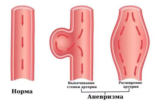 виды аневризм