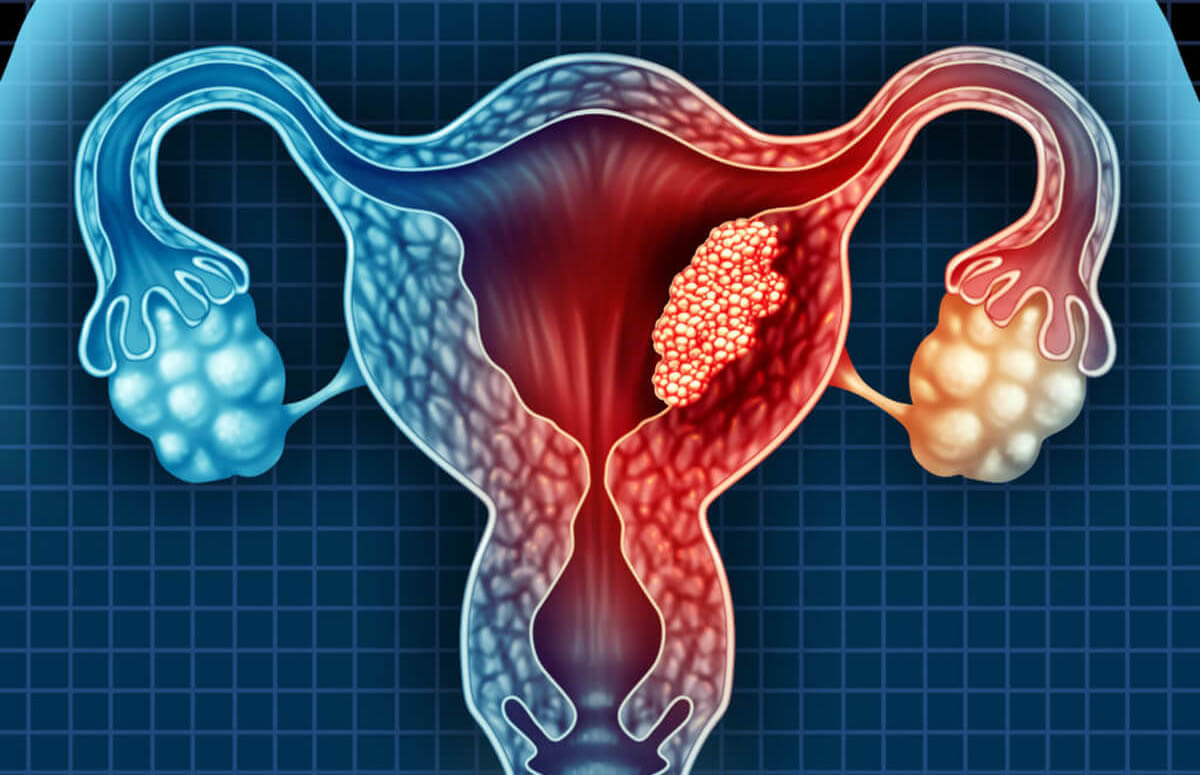 Uterine cancer – what are the consequences and can it be cured?