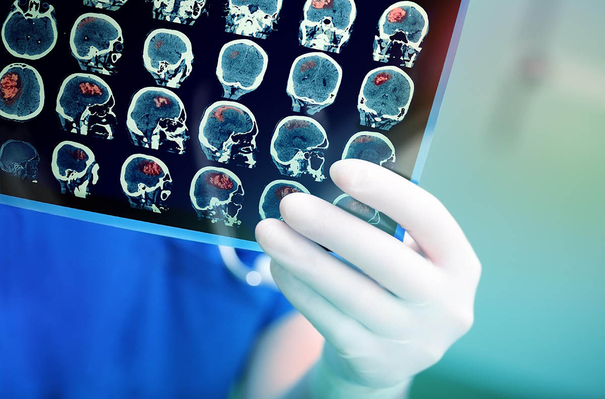 Что такое невринома слухового нерва и чем она опасна?
