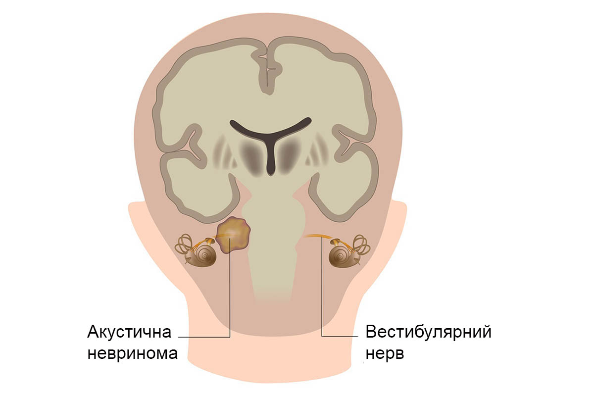 невринома слухового нерва види