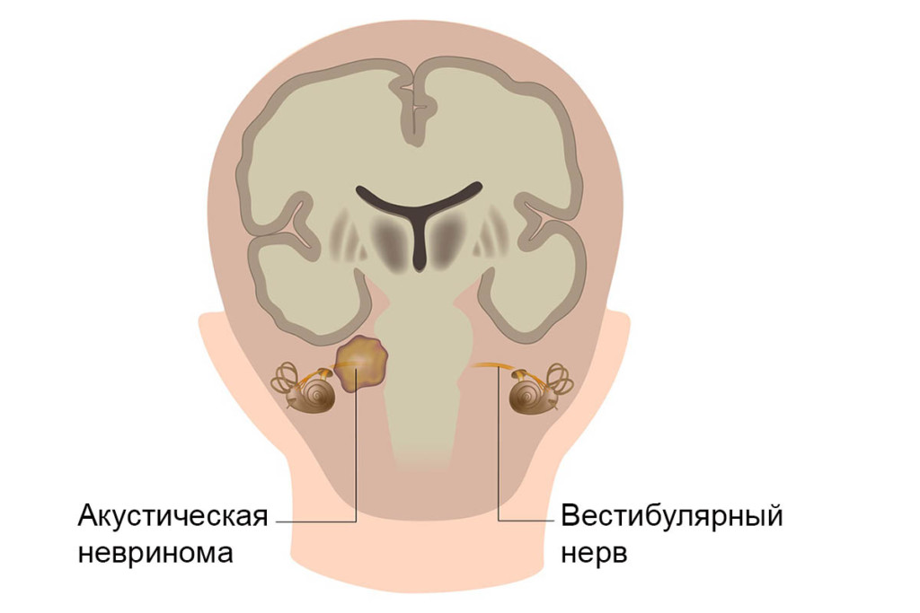 невринома слухового нерва виды 