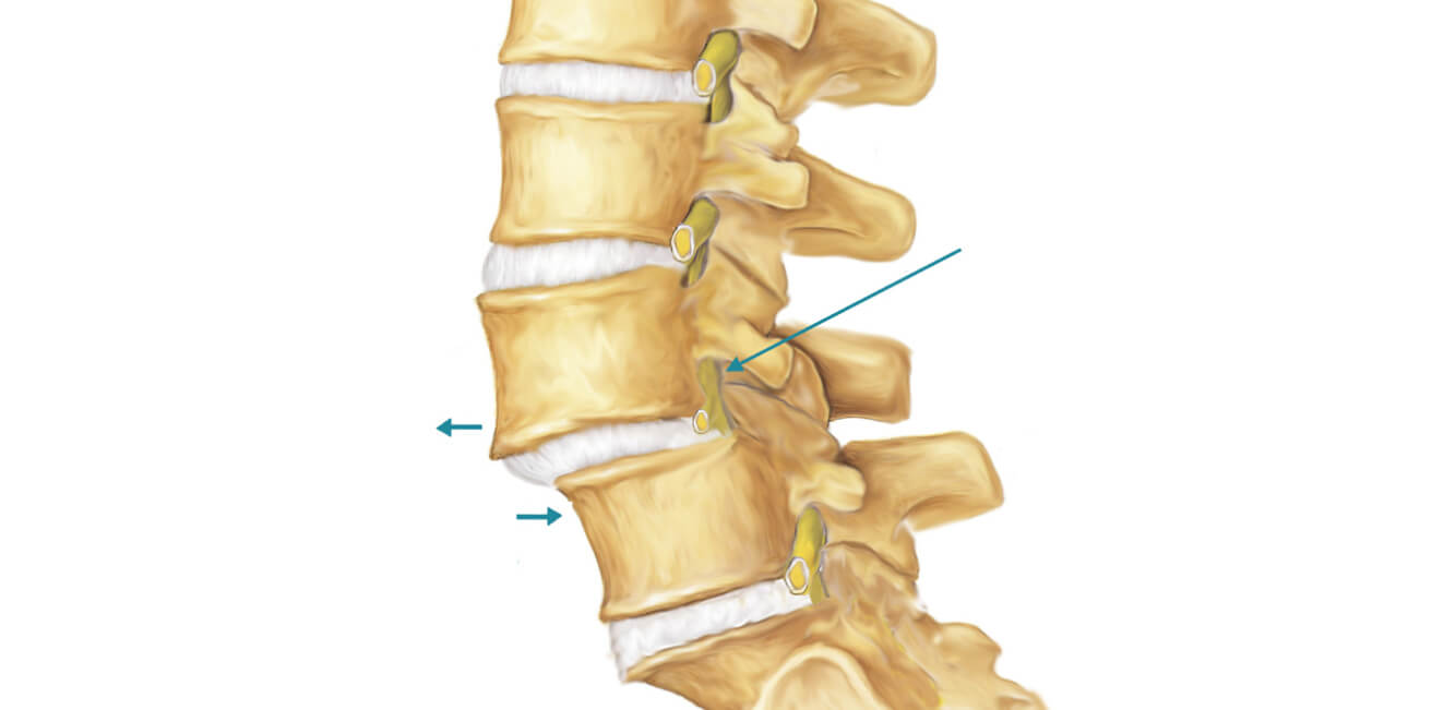 What is spondylolisthesis and why is it dangerous?