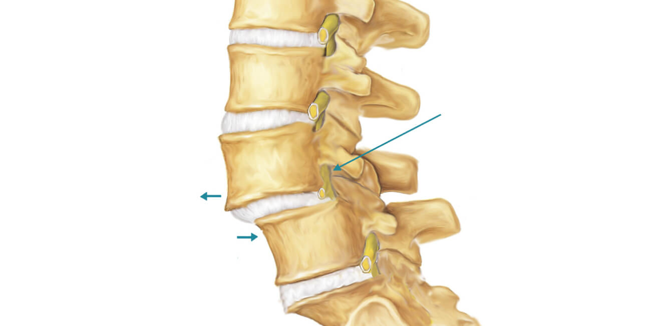 Что такое спондилолистез и чем он опасен?