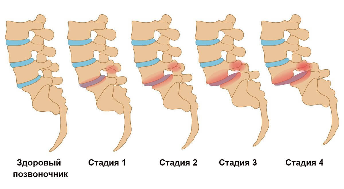 Спондилолистез стадии развития