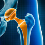 Best materials for hip implants found