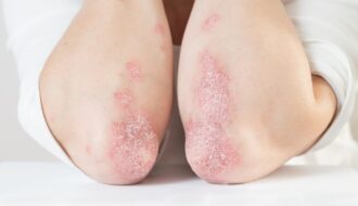 Cancer patients receiving immune checkpoint inhibitors found to have an increased risk of developing psoriasis