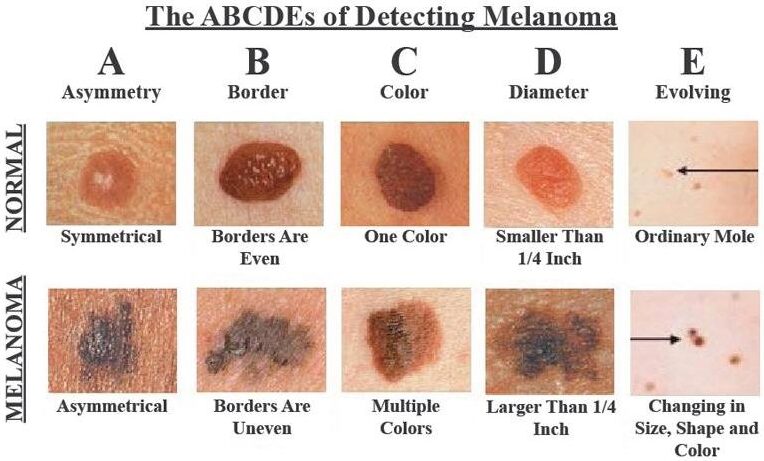 ABCDE Rule for Identifying Suspicious Moles