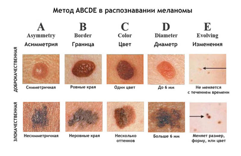 Рак кожи Метод ABCDE