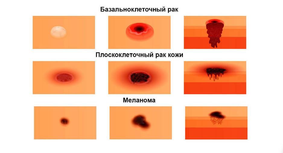 рак кожи виды