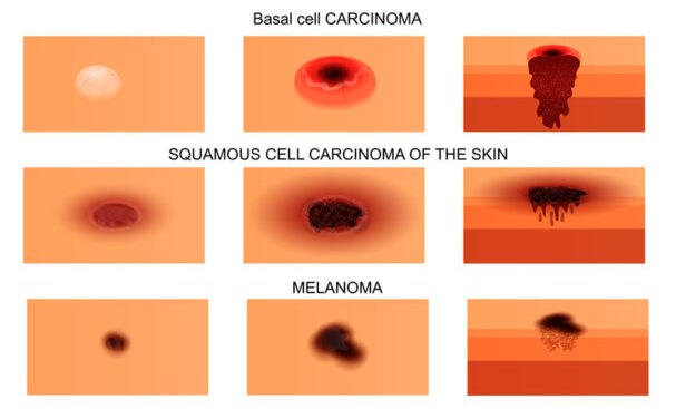 types of skin cancer