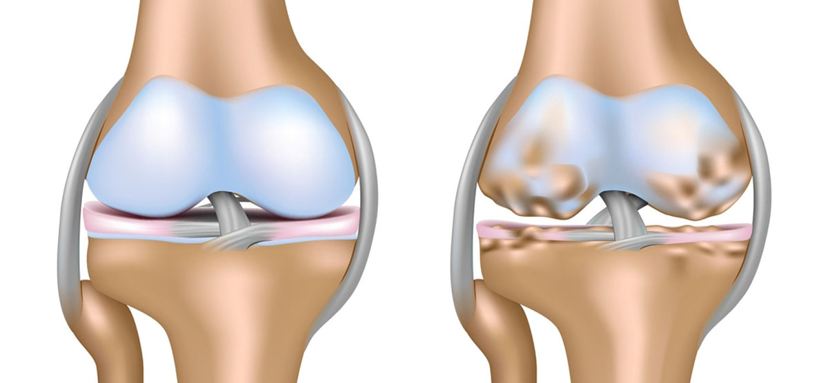 артрит и артроз разница