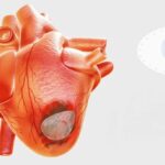 ‘Heart patch’ from stem cells may cure heart failure