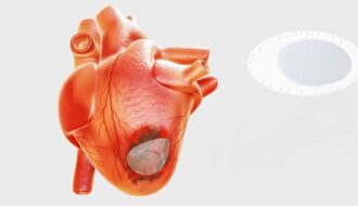 ‘Heart patch’ from stem cells may cure heart failure