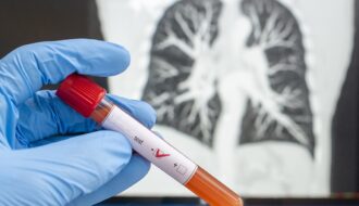 Biomarker testing reduces lung cancer deaths by 40%