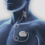 Vagus nerve stimulation helps PTSD patients in the long term