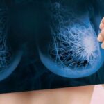A healthy gut microbiome before chemotherapy protects breast cancer patients from cardiotoxicity